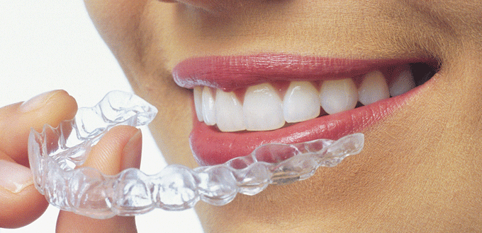 Niềng răng không mắc cài Invisalign tại bệnh viện Worldwide