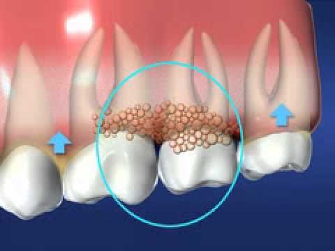 Cấp độ của bệnh nha chu