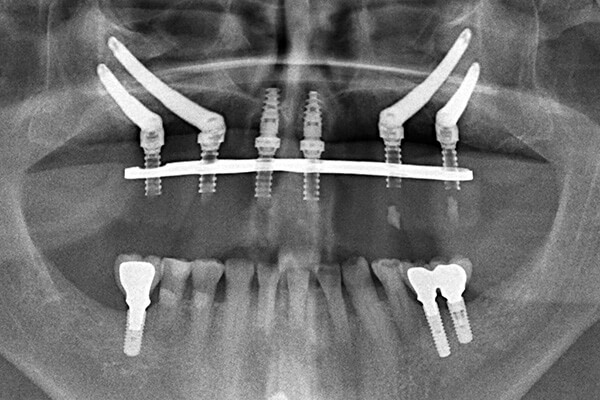 Hình X-Quang của một ca cắm ghép Zygoma Implant
