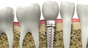 solutions for missing teeth