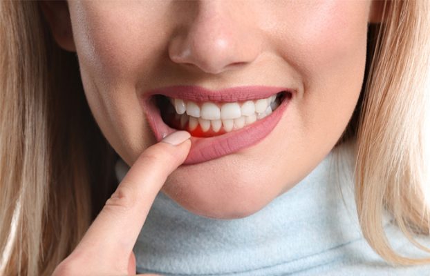 điều trị viêm nướu răng tại nhà hiệu quả