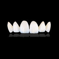Nano-Emax là 1 trong các loại răng sứ phổ biến hiện nay 