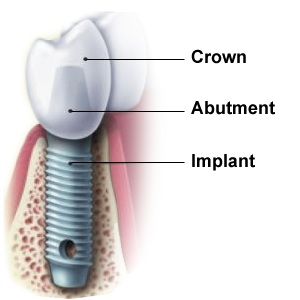 implant