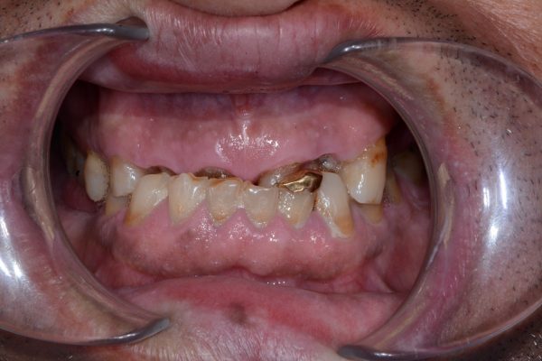 Bệnh nhân nam 53 tuổi bị mòn răng hàm trên do nghiến răng