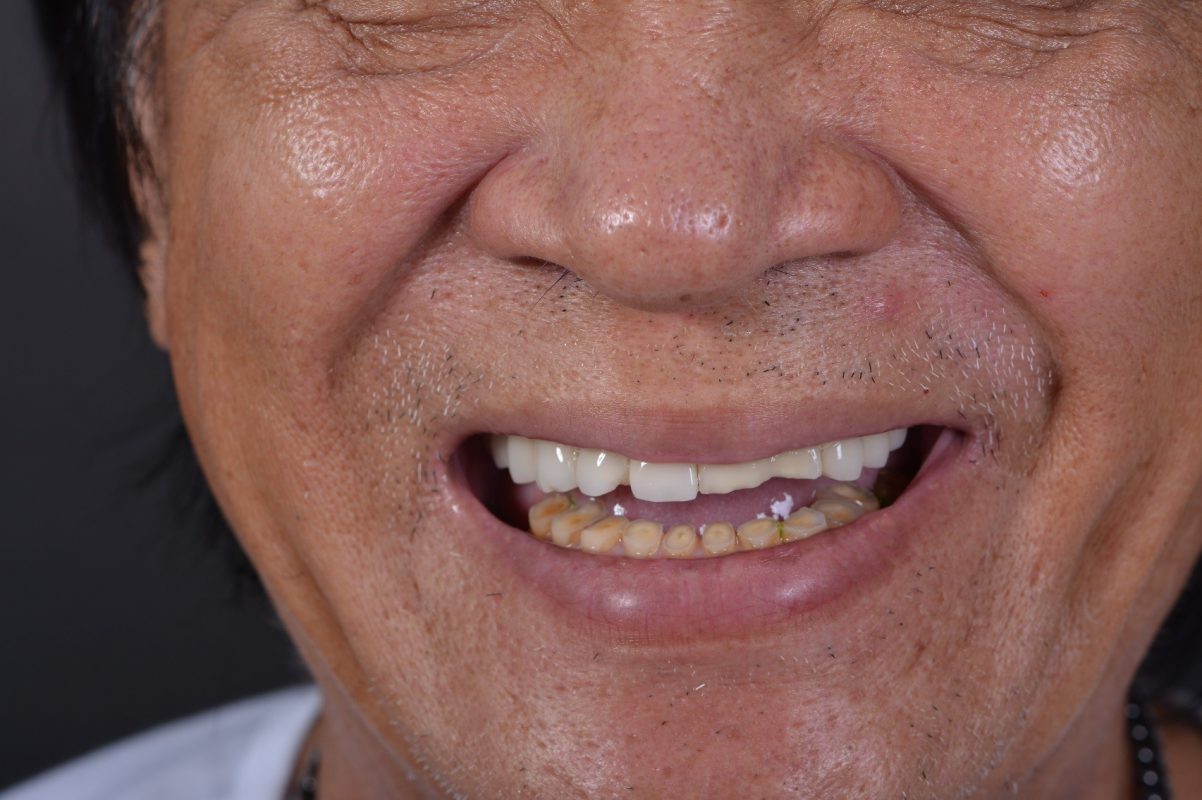 Bệnh nhân nam 50 tuổi bị mòn răng nghiêm trọng ở hàm dưới do nghiến răng lúc ngủ