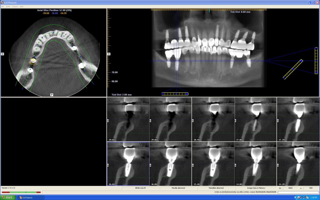 Cone Beam CT 03 - nhakhoa dr hung