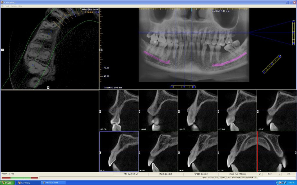 Cone Beam CT 07 nha khoa dr hung