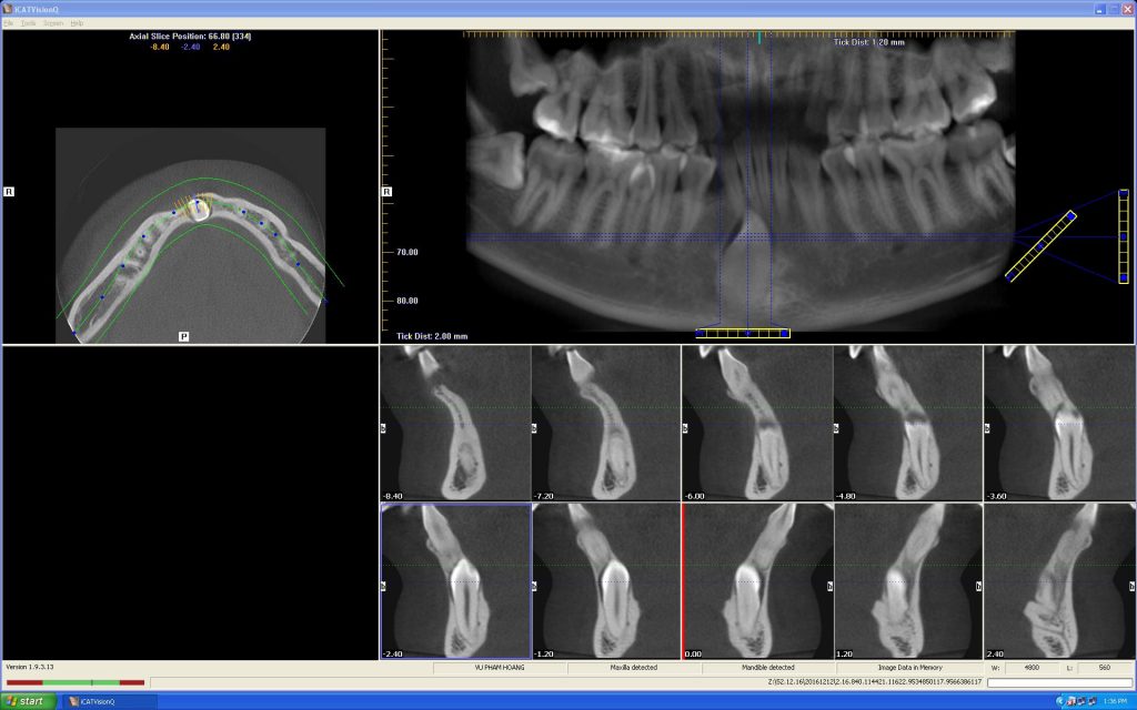 Cone Beam CT 09 nha khoa drhung