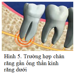 RANG KHON NHA KHOA DR HUNG 04