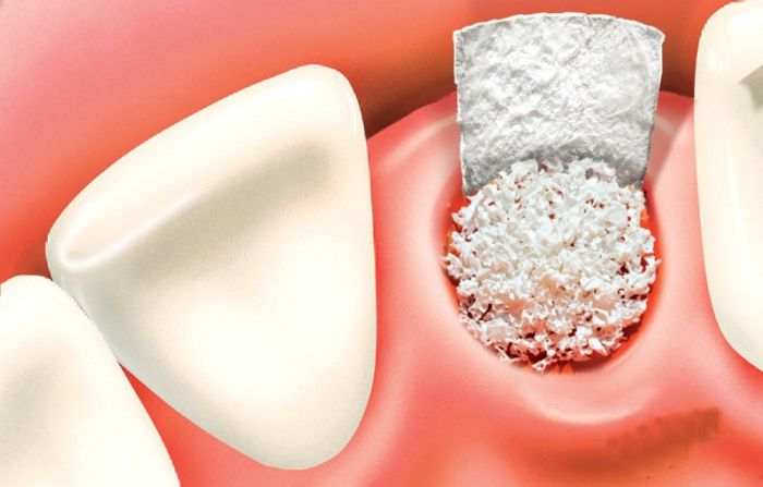 Tại sao cần ghép thêm xương khi nhổ răng và đặt Implant tức thì?