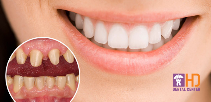 răng sứ implant giá bao nhiêu