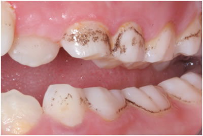 Điều trị viêm nướu vết dính trên răng bằng phương pháp mới