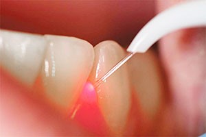 implant cho người mất răng toàn hàm
