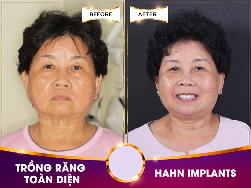 Cấy ghép Implant tại nha khoa Dr Hùng