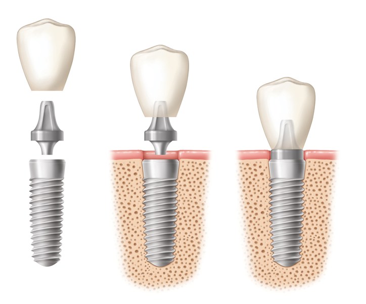 dental implant illustration