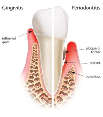 TREATMENT FOR GINGIVITIS AND PERIODONTITIS