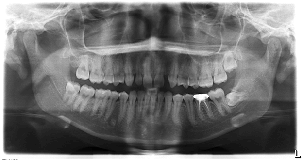 Wisdom Teeth - 2020