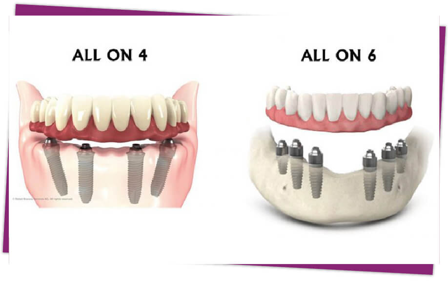 trồng răng implant all on 4