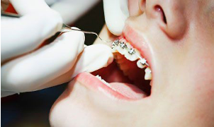 quy trình niềng răng