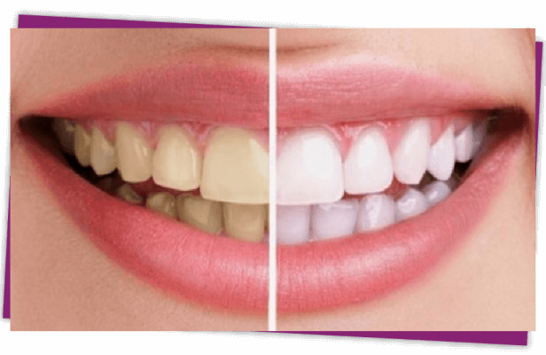 cách làm trắng răng tự nhiên