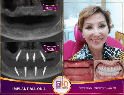 trồng răng implant cho mất răng toàn hàm