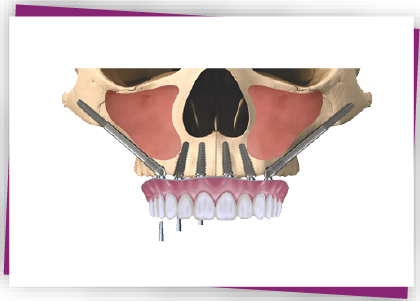 zygoma implant tại bệnh viện răng hàm mặt Worldwide