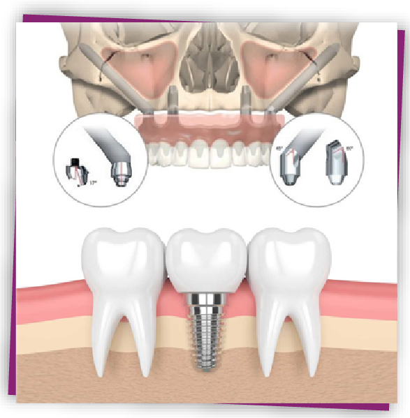 Zygoma Implant