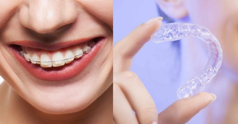 Niềng răng không mắc cài Invisalign có nhiều ưu điểm so với phương pháp truyền thống