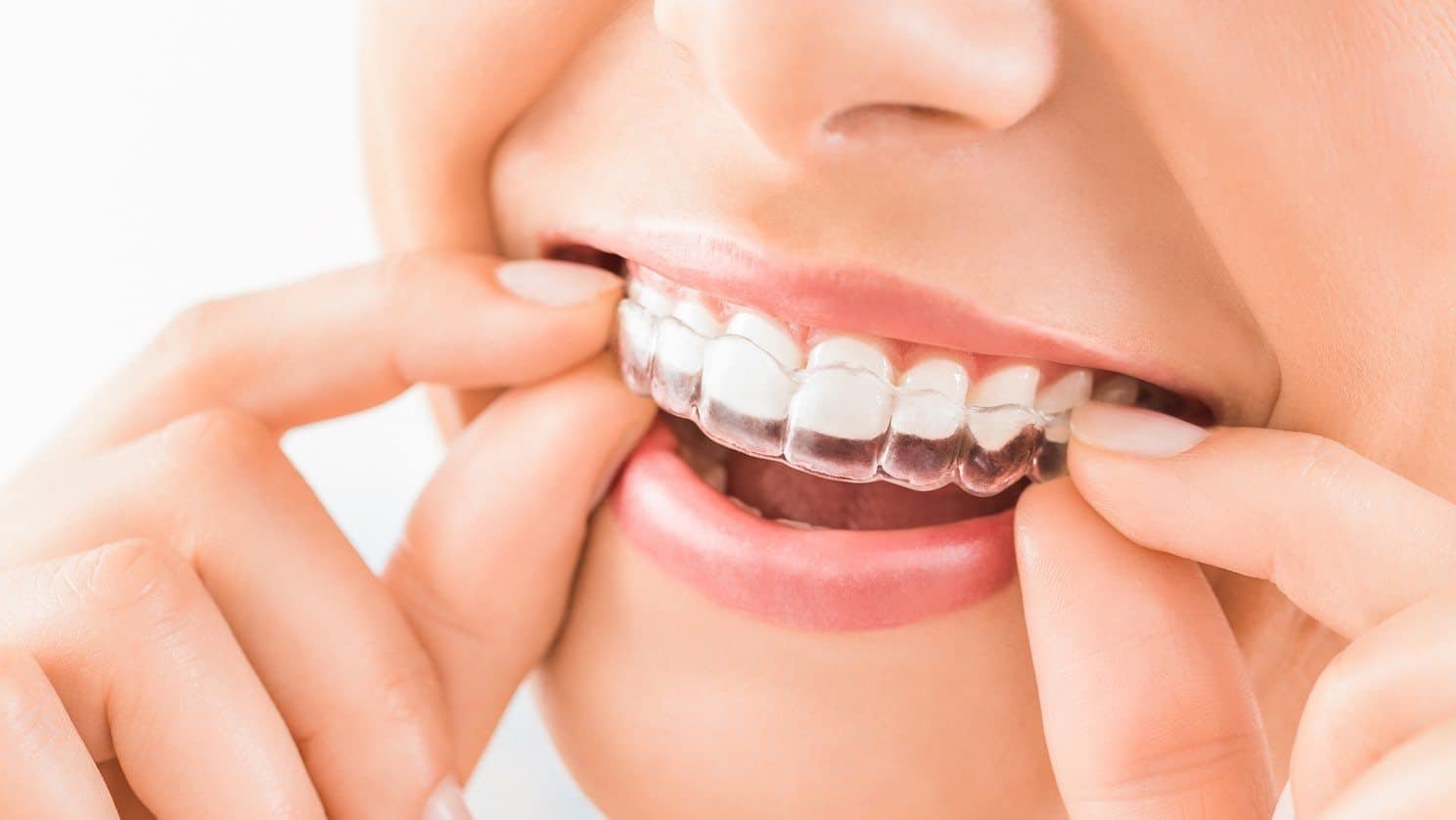 Giá niềng răng Invisalign liệu có tương xứng với hiệu quả?