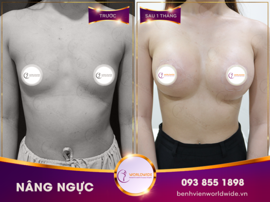 Breast augmentation 6.0