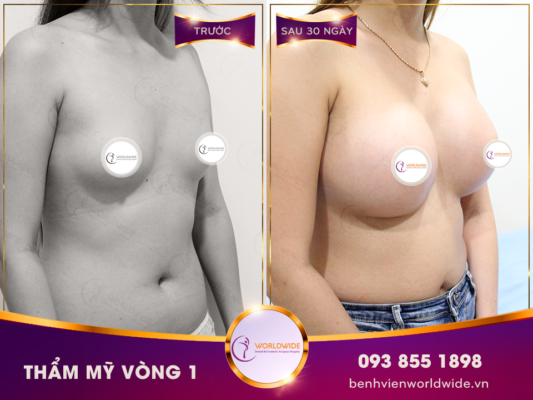 Fat Transfer Breast Augumentation