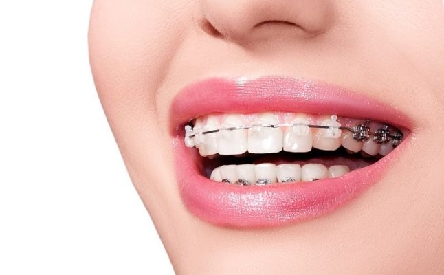 Ngoài vấn đề thẩm mỹ, niềng răng mắc cài có nhiều bất tiện và đau hơn so với chỉnh nha Invisalign.