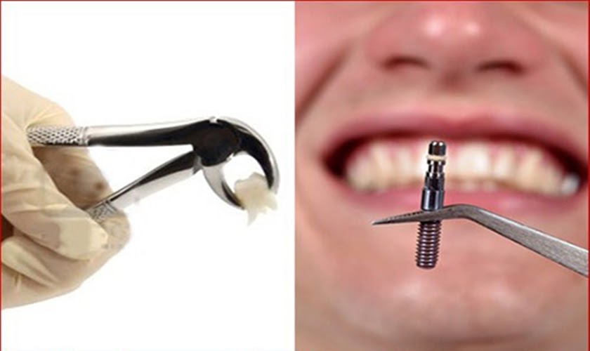 Tất cả về Implant - Việt Nam 2020 Thay răng vừa nhổ bằng răng Implant tức thì