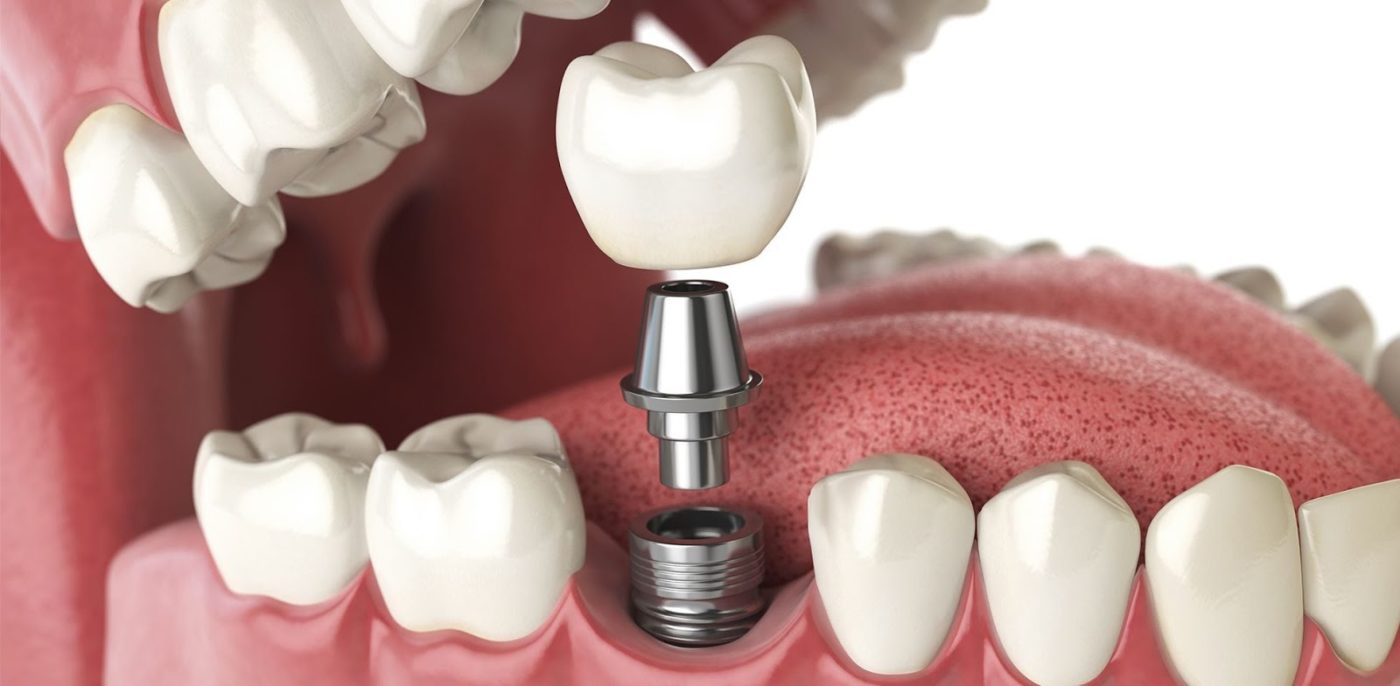 Tất cả về Implant - Việt Nam 2020 Cần khoan một lỗ nhỏ vào xương hàm để trồng răng Implant