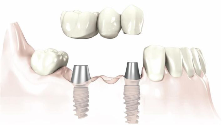 Trồng răng Implant 