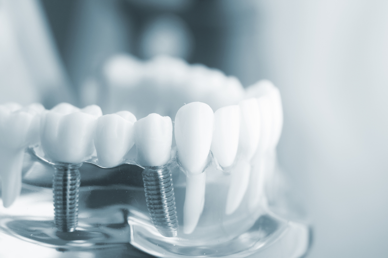 Tất cả về Implant - Việt Nam 2020 Bác sĩ có thể thực hiện một hoặc nhiều trụ Implant tùy thuộc vào tình trạng mất răng của bạn