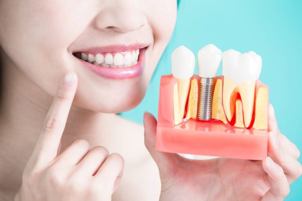 Trồng răng Implant giúp bạn khôi phục khả năng ăn nhai và vẻ ngoài tự tin.