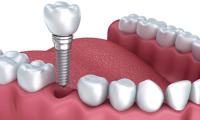 Implant là giải pháp trồng răng hiệu quả nhất hiện nay