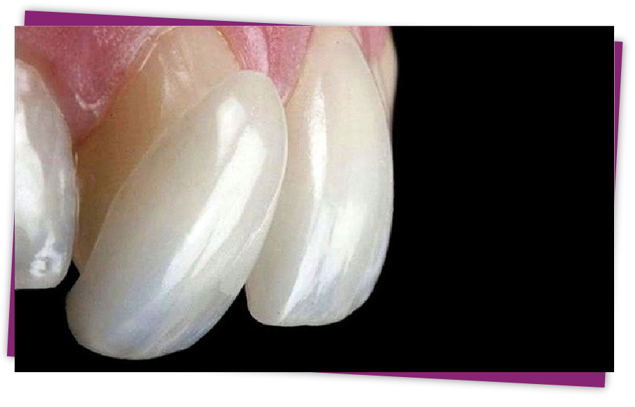 veneer sứ