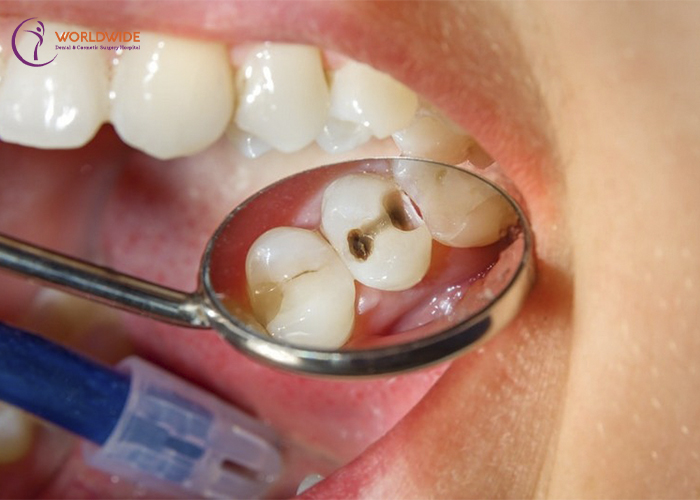 bệnh sâu răng