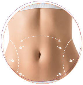 Tummy Tuck