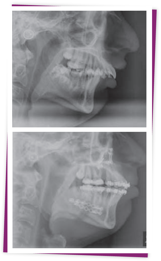 What Is Overbite? Dental Knowledge.