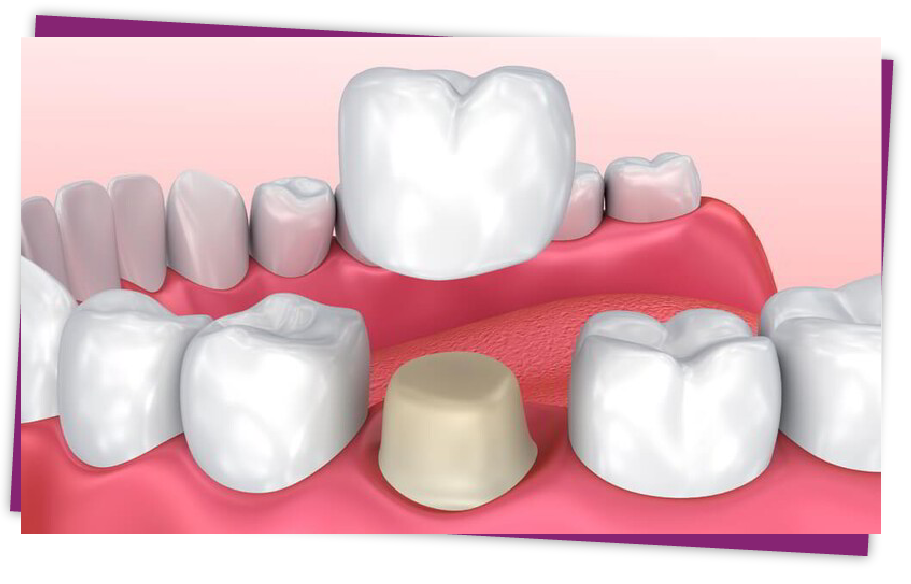 cosmetic restoration