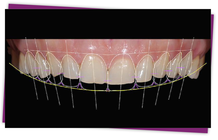 Smile Design