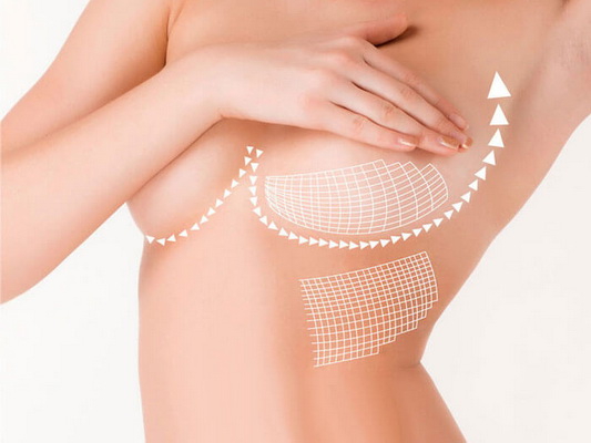 Nâng ngực hiệu quả bằng túi nâng ngực Nano Chip