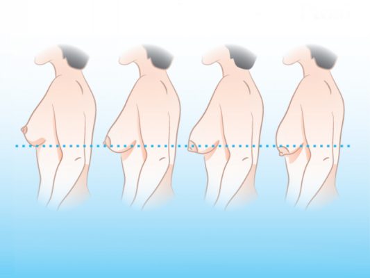 Nâng ngực chảy xệ giá bao nhiêu sẽ phụ thuộc phần lớn vào mức độ chảy xệ của ngực