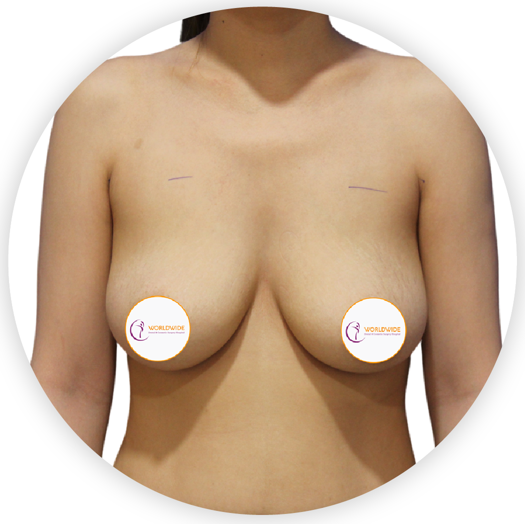 BREAST LIFT