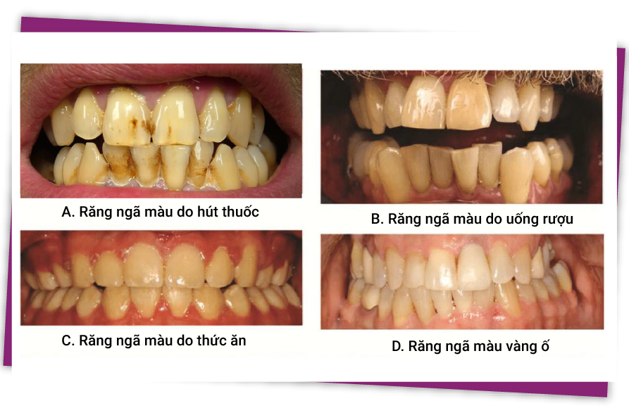 teeth whitening in vietnam