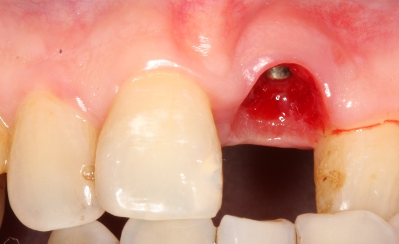implant placement after teeth removal