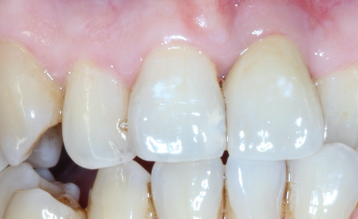 implant placement after teeth removal